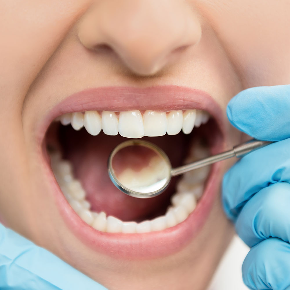 All-on-4 dental implants near Pico Rivera