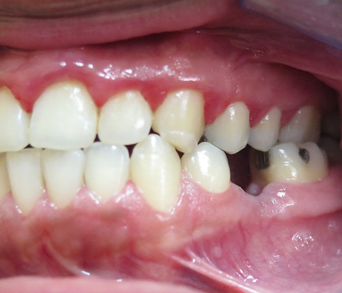 Dental implant before