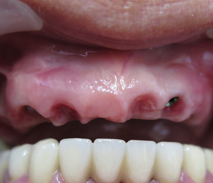 Dental implant before
