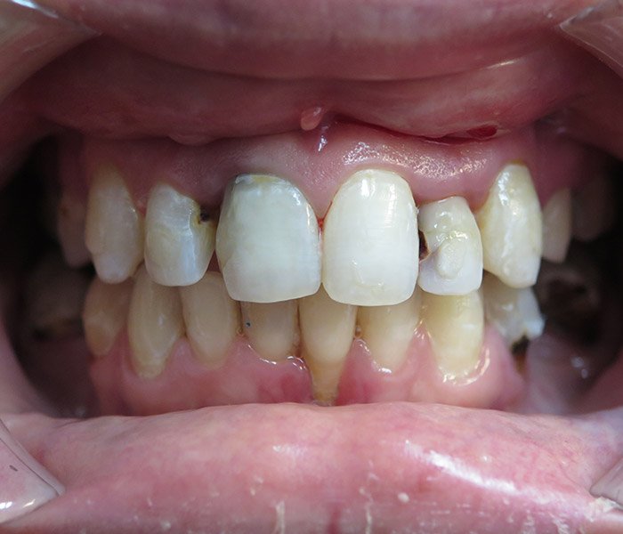 Dental implant before