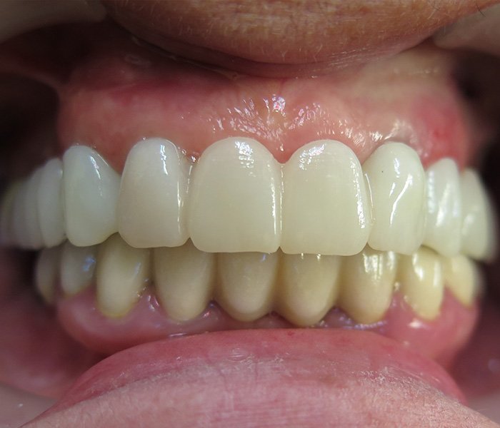 Dental implant after